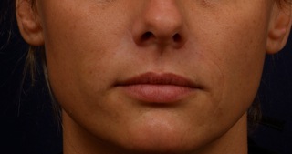 After Restylane to Nasal Labial Folds