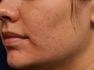 After smoothbeam laser for acne 2