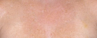 Photodynamic-Photorejuvenation-After