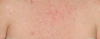 Photodynamic-Photorejuvenation-Before