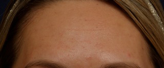 Smoothbeam-After