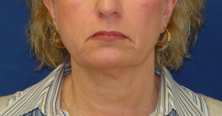 Thermage after