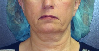 Thermage before