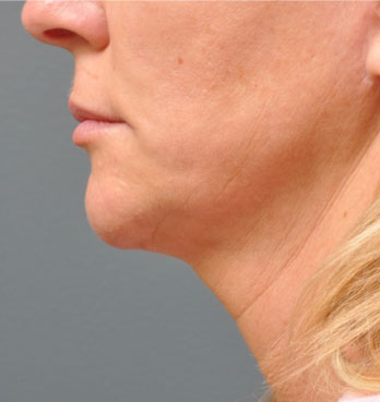 ultherapy-after