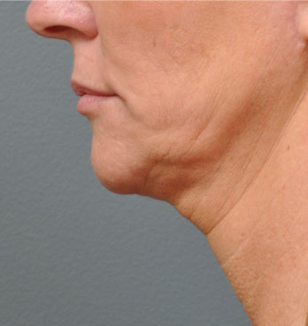 ultherapy-before
