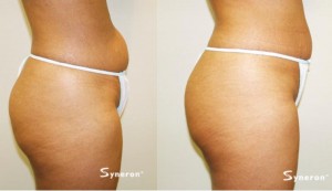 Before and After Velashape III Abdomen (circumference reduction)