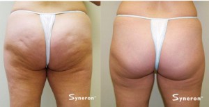 Before and After Velashape III Buttocks (cellulite reduction)