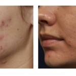 June is National Acne Awareness month