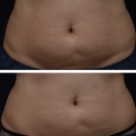 My CoolSculpting<sup>®</sup> Experience- A Patient’s Perspective