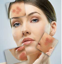 Rosacea