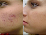 June is Acne Awareness Month