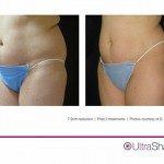 Reduce Stubborn Pockets of Fat Fast With UltraShape<sup>®</sup>