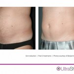 UltraShape<sup>®</sup>: Non-Surgical Fat Reduction for Men