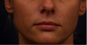 After Restylane Nasal Folds