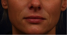 Before Restylane Nasal Folds