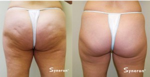 Before and After Velashape III Buttocks (cellulite reduction)