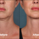 What Are the Benefits of KYBELLA<sup>™</sup>?
