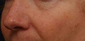 after_rosacea