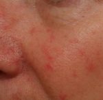 Rosacea FAQs – Rosacea Awareness Month