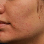 Honoring Acne Awareness Month: Acne Facts Pt. 2