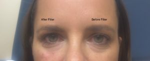 Before and After Under eye filler