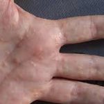 Let’s talk about Hand Eczema