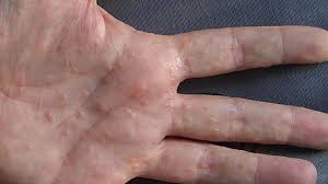 Let’s talk about Hand Eczema