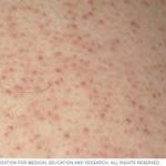 What is Keratosis Pilaris?