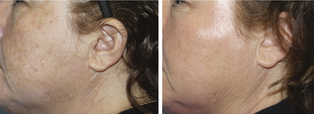 Before and after Rejuvenize Peel