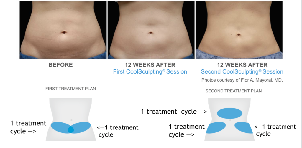 CoolSculpting in San Diego