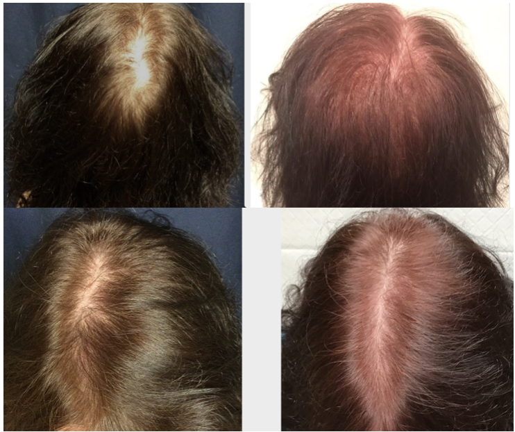 Featured Treatment: PRP Hair Restoration