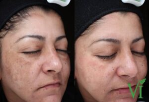 Before and after VI Peel