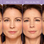 Botox Talks: Age is Just a Number 