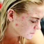 Acne Across the Ages: Understanding and Treating at Every Stage